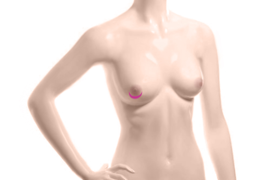 Уменьшение и коррекция формы ареолов на груди | Клиника HLC