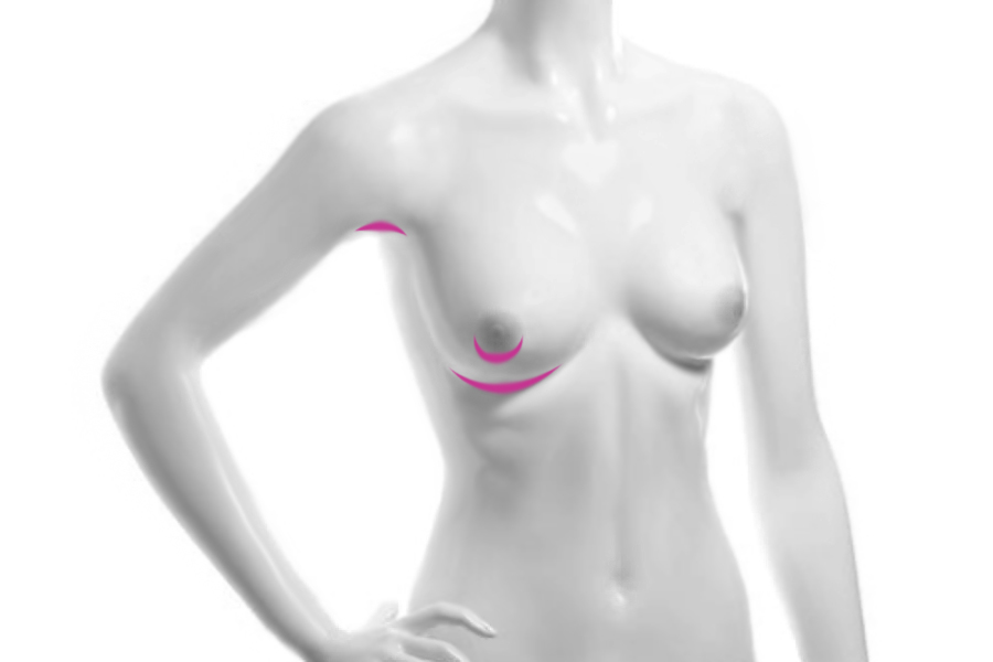 разрезы во время операции по увеличению груди