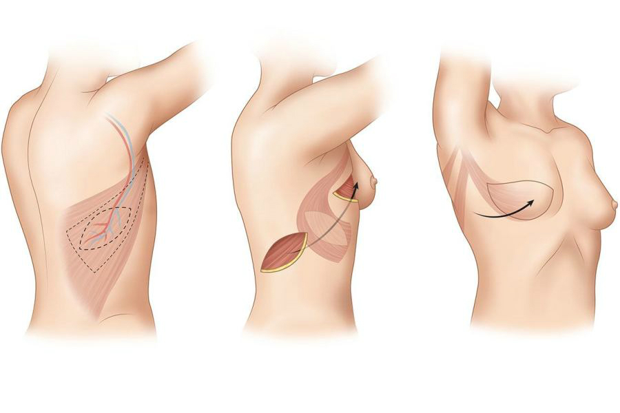 Восстановление груди после мастэктомии